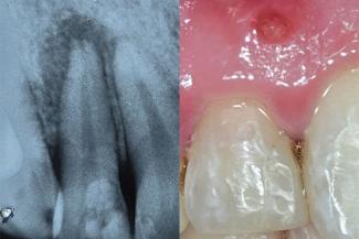 Endodontics (Root Canal Treatment) | Alfonso Dental Clinic